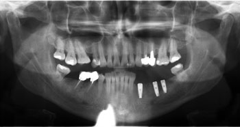 Restoration of dentition defect in posterior teeth