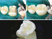 Металлокерамические коронки для зубов