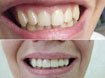 реставрация зубов по низким ценам