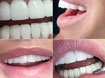 реставрация зубов по низким ценам