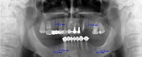 імплантація зубів Київ