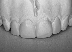 восковое моделирование зубов