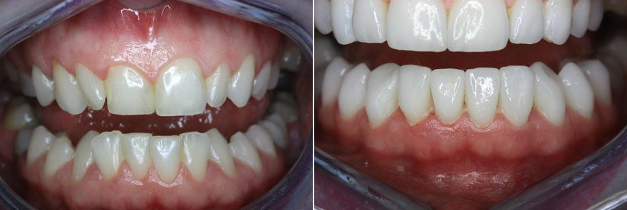 реставрации зубов
