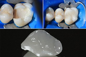 Примеры восстановления дефектов зуба керамическими вкладками