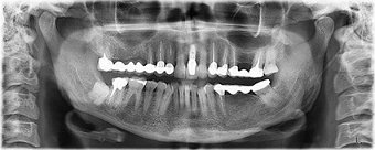 Имплантация зубов Киев цены