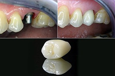 Вставить импланты зубов цена