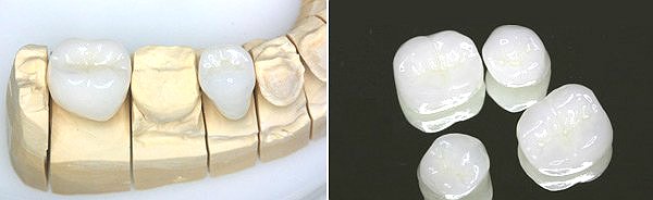 Реставрація зубів вартість