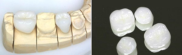 Скільки коштує реставрація зубів