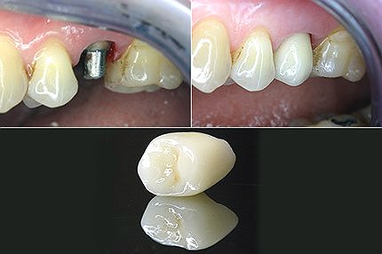 Воспаление зубного канала лечение