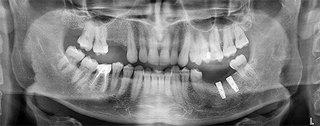 Імпланти зубів ціни Київ