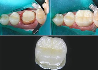 Протезування зубів безметаловою керамікою