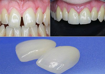 Реставрация передних зубов цена