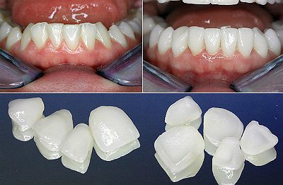 Реставрация зубов винирами