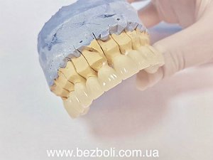 Безметалловая керамика на передние зубы цена