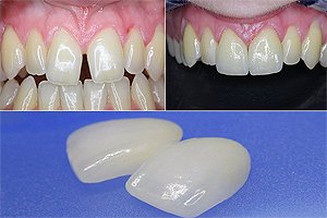 Безметалова кераміка стоматологія