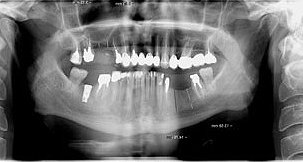Имплантация зубов низкие цены
