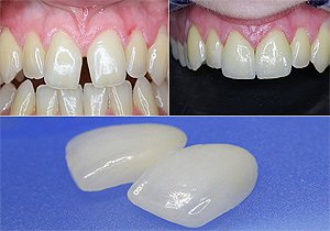 Реставрация зубов керамическими винирами