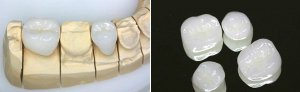 Протезування зубів безметаловою керамікою ціна