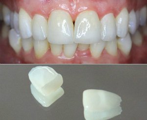 Вартість керамічних вінірів для зубів