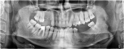 Послуги імплантації зубів ціна