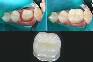 Протезирование зубов на имплантах цена Левобережная