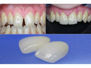 Установить керамические виниры на передние зубы