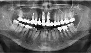 Имплантация зубов киев левый берег