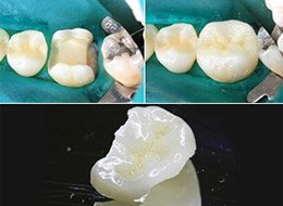 Протезування зубів частковими зйомними протезами